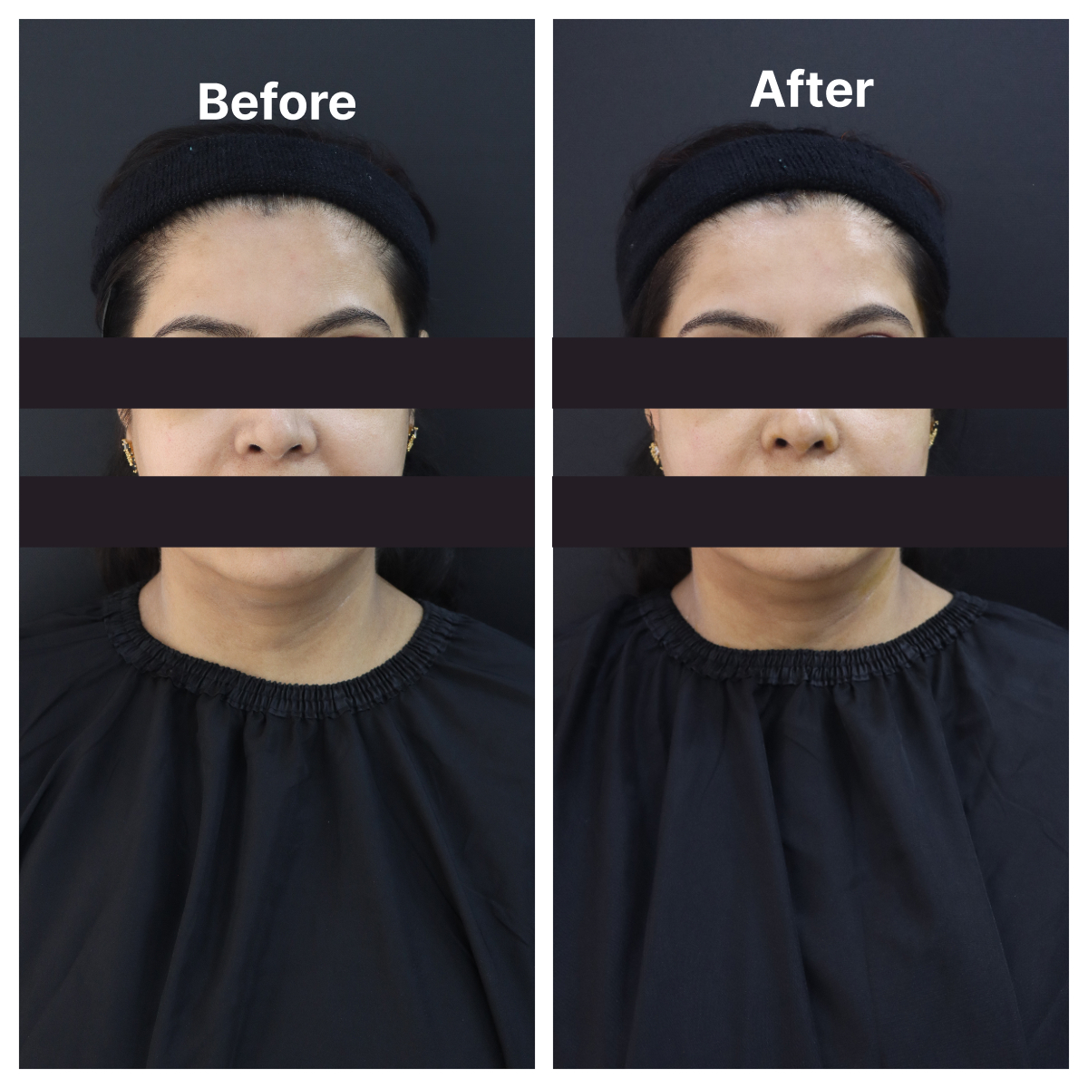 Thread Lift result KOQ10